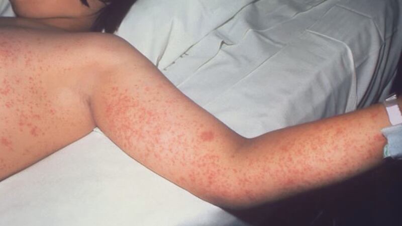 Symptoms appear one to two weeks after contact with the virus and include high fever, cough,...